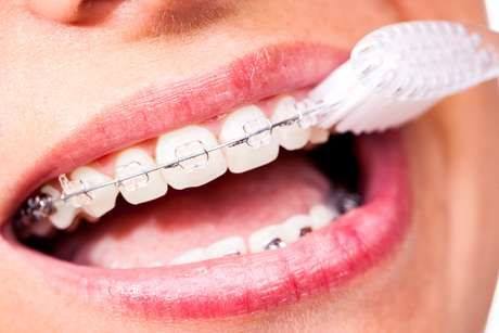 牙齒矯正期重清潔